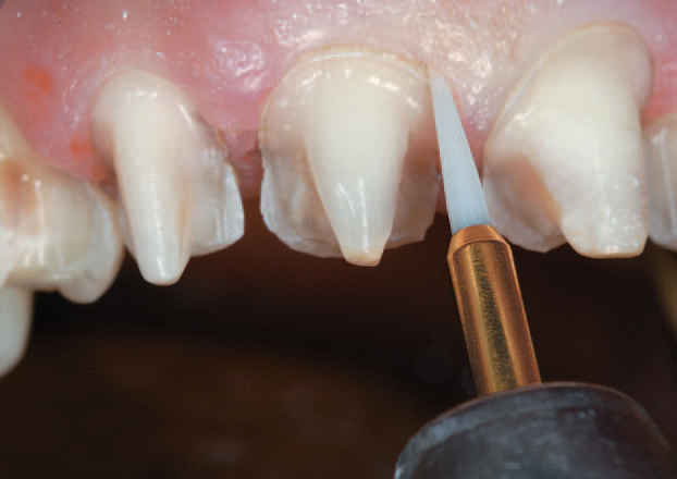 Триммер мягких тканей 250-016-FG - раскрытие бороздки